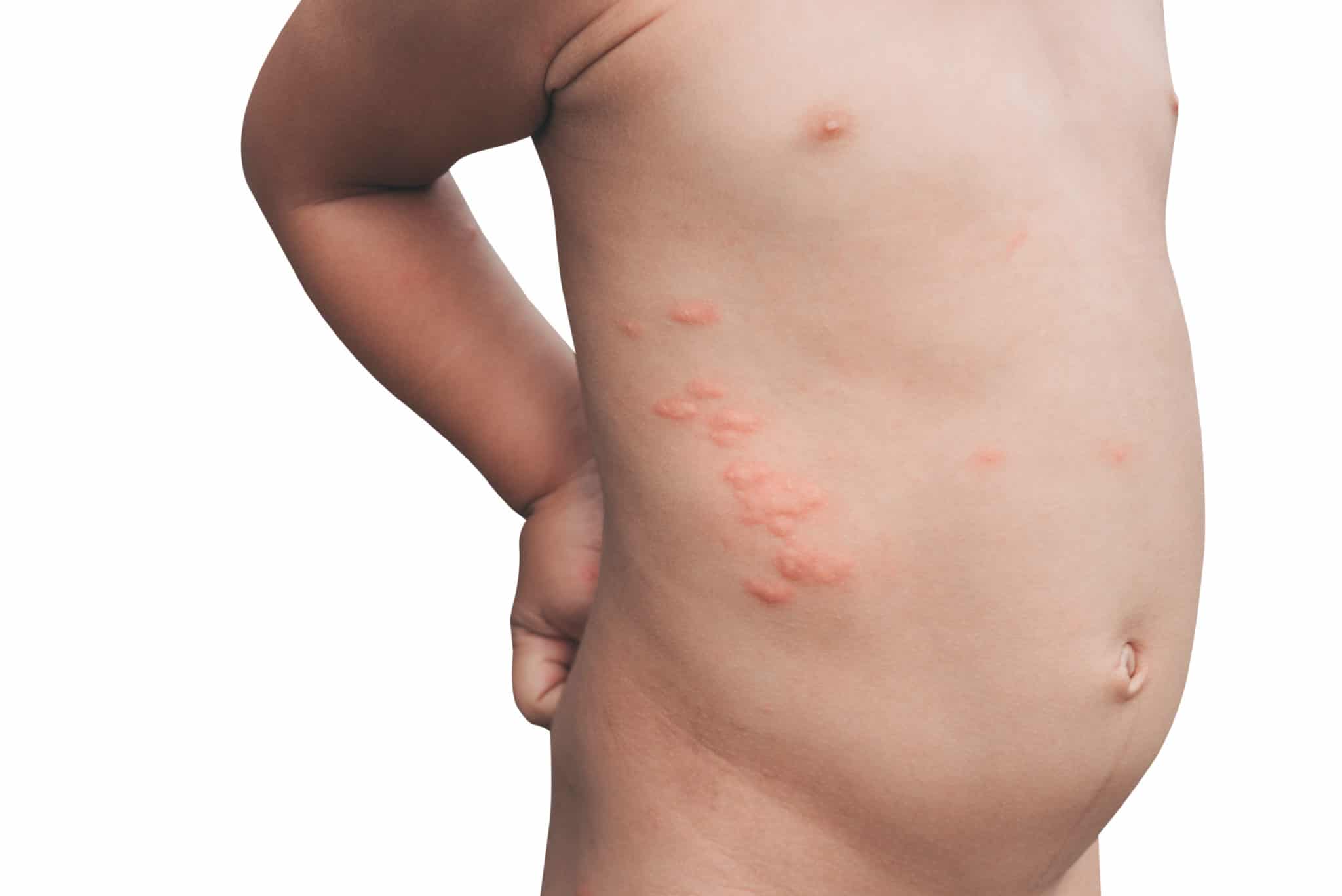 punture zanzare bambini gonfiore
